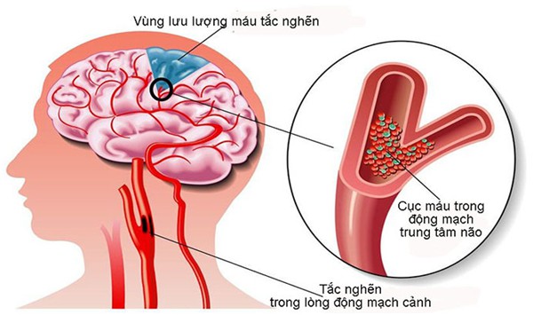 Hoạt huyết dưỡng não: Không nên ngộ nhận - Ảnh 1. Hoạt huyết dưỡng não: Không nên ngộ nhận - Ảnh 1.