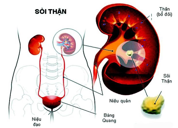 Biến chứng sỏi thận - Ảnh 1. Biến chứng sỏi thận - Ảnh 1.