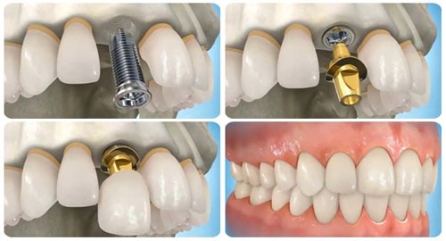 Điều kỳ diệu, răng đã mất “mọc lại” chỉ 4 tuần - Ảnh 2. Điều kỳ diệu, răng đã mất “mọc lại” chỉ 4 tuần - Ảnh 2.
