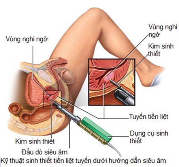 Ung thư tuyến tiền liệt - Ảnh 1. Ung thư tuyến tiền liệt - Ảnh 1.