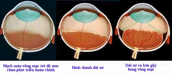 Giúp trẻ sinh non thoát khỏi nguy cơ mù lòa - Ảnh 1. Giúp trẻ sinh non thoát khỏi nguy cơ mù lòa - Ảnh 1.