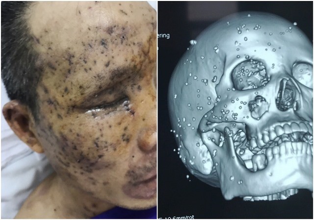 Một bệnh nhân bị cả trăm mảnh kim loại găm vào mặt - Ảnh 1. Một bệnh nhân bị cả trăm mảnh kim loại găm vào mặt - Ảnh 1.