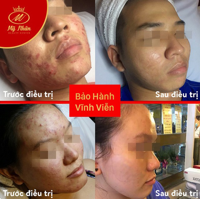 Trị mụn hiệu quả với công nghệ quang xung bước sóng nano - Ảnh 1. Trị mụn hiệu quả với công nghệ quang xung bước sóng nano - Ảnh 1.