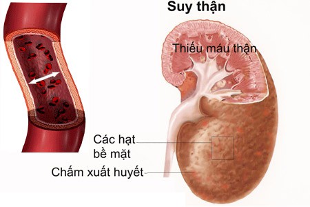 Trị gút mạn tính: tăng cường chức năng thận với Hoàng Tiên Đan - Ảnh 2. Trị gút mạn tính: tăng cường chức năng thận với Hoàng Tiên Đan - Ảnh 2.