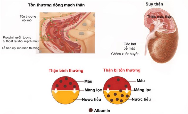 Những biến chứng nguy hiểm của bệnh sỏi thận, bạn có biết? - Ảnh 1. Những biến chứng nguy hiểm của bệnh sỏi thận, bạn có biết? - Ảnh 1.