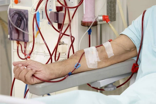 Những điều cần biết về chạy thận nhân tạo - Ảnh 1. Những điều cần biết về chạy thận nhân tạo - Ảnh 1.