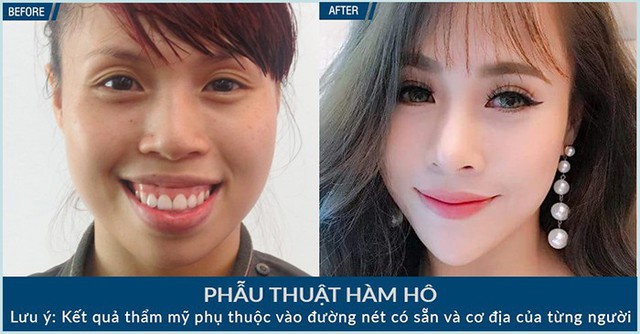 Hô, móm phải phẫu thuật hàm hay chỉ niềng răng? - Ảnh 1. Hô, móm phải phẫu thuật hàm hay chỉ niềng răng? - Ảnh 1.