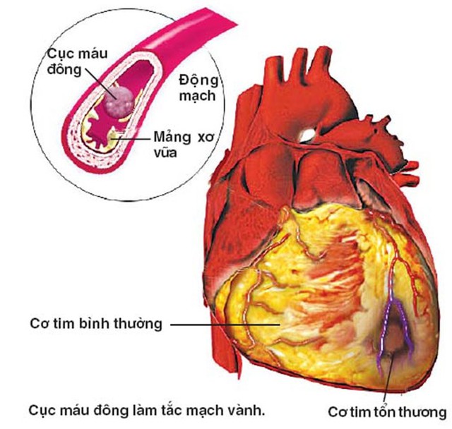 Cảnh giác đột quỵ não do tim khi giao mùa - Ảnh 1. Cảnh giác đột quỵ não do tim khi giao mùa - Ảnh 1.