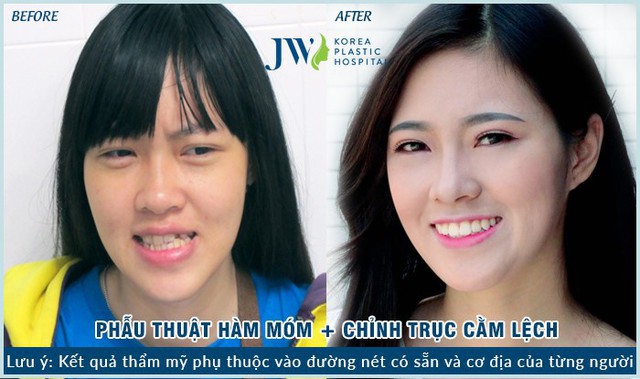 Hô, móm phải phẫu thuật hàm hay chỉ niềng răng? - Ảnh 3. Hô, móm phải phẫu thuật hàm hay chỉ niềng răng? - Ảnh 3.