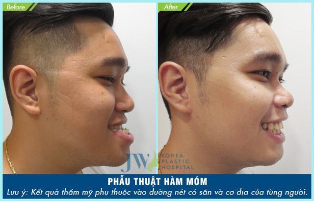 Hô, móm phải phẫu thuật hàm hay chỉ niềng răng? - Ảnh 5. Hô, móm phải phẫu thuật hàm hay chỉ niềng răng? - Ảnh 5.