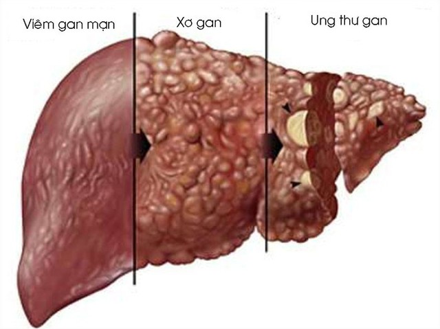 Viêm gan mạn tính tự miễn - Ảnh 1. Viêm gan mạn tính tự miễn - Ảnh 1.