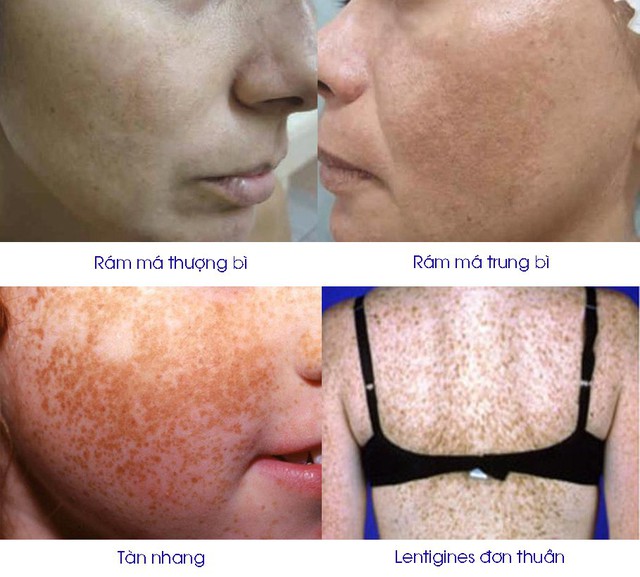Rối loạn tăng sắc tố da mặt - Ảnh 1. Rối loạn tăng sắc tố da mặt - Ảnh 1.