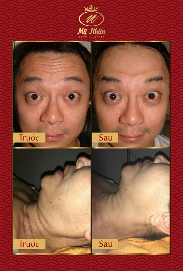 Phương pháp Laser Liposonic xóa nhăn, phục hồi da chảy xệ - Ảnh 1. Phương pháp Laser Liposonic xóa nhăn, phục hồi da chảy xệ - Ảnh 1.