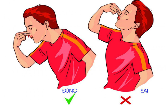 Làm gì khi chảy máu mũi? - Ảnh 1. Làm gì khi chảy máu mũi? - Ảnh 1.