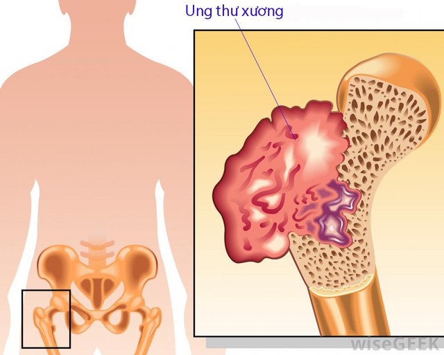 Phòng bệnh ung thư xương - Ảnh 1. Phòng bệnh ung thư xương - Ảnh 1.