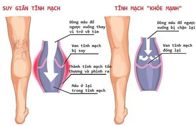 Giãn tĩnh mạch chân - Ảnh 1. Giãn tĩnh mạch chân - Ảnh 1.