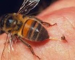Cứu sống bệnh nhân bị ong chích nhờ sử dụng kỹ thuật Ecmo