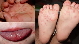Bệnh tay chân miệng: Cần phòng ngừa ra sao để tránh lây lan?