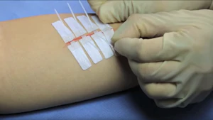 Việc khâu vết thương sẽ không còn đau đớn nữa nhờ miếng dán thần kì này