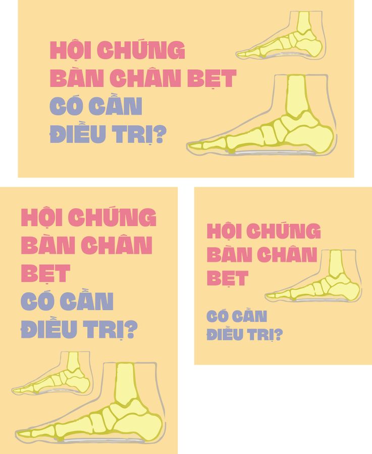 Hội chứng bàn chân bẹt có cần điều trị?