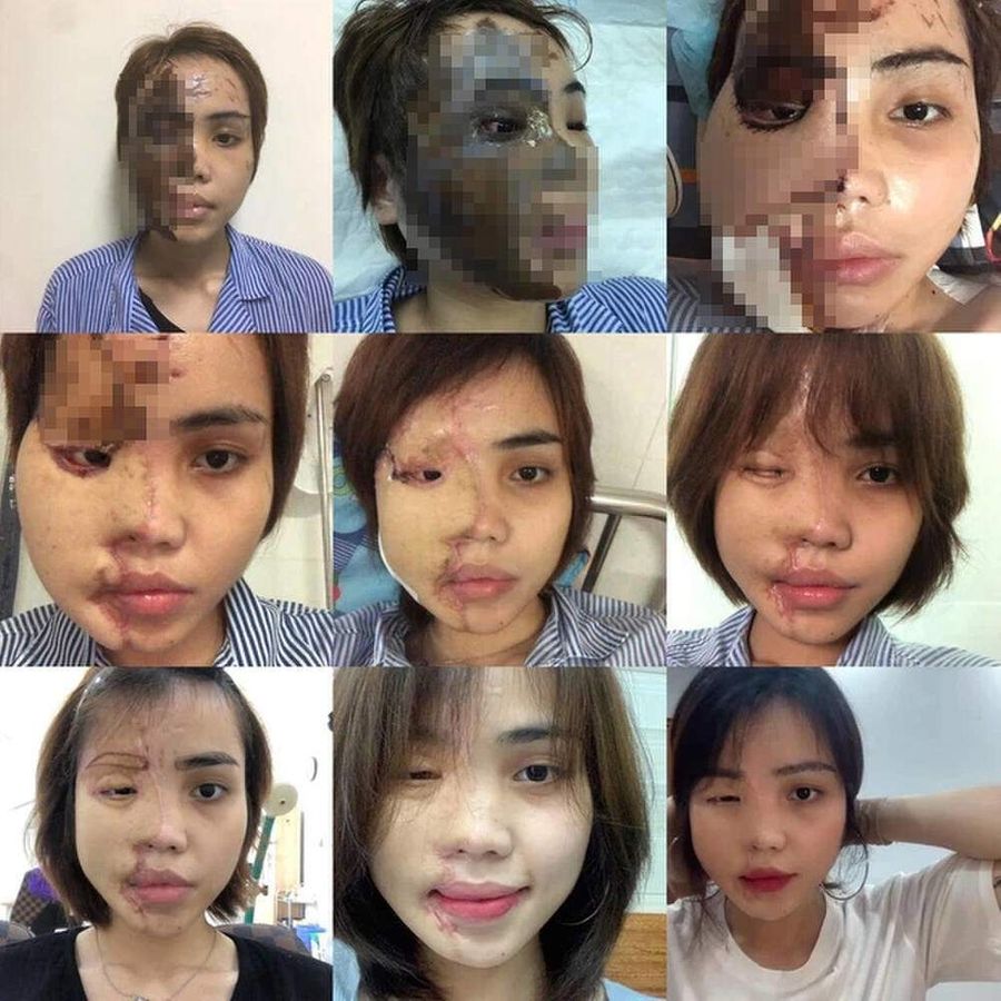 Cô gái bị chồng sắp cưới tạt axit cách đây 3 năm 