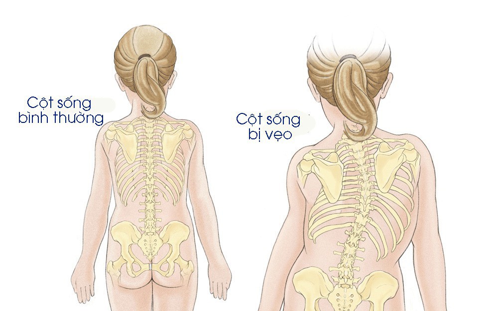 Tật cong vẹo cột sống ảnh hưởng đến chất lượng cuộc sống của trẻ