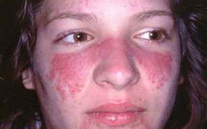 Ác mộng dữ dội có thể báo hiệu những bệnh nguy hiểm- Ảnh 2. Lupus ban đỏ, căn bệnh nguy hiểm ít được biết đến
