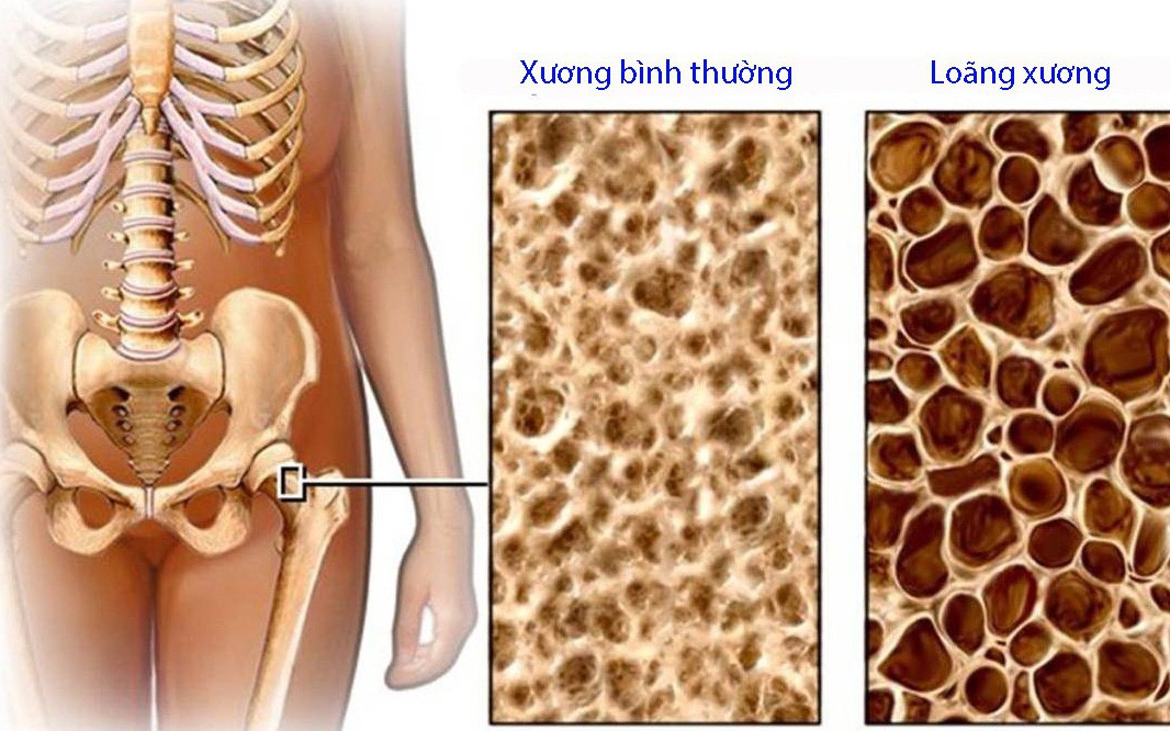 Cảnh báo suy tuyến thượng thận, mặt to tròn vì lạm dụng thuốc kháng viêm- Ảnh 2. Tai biến do lạm dụng corticoid