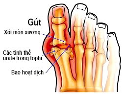 Tránh hiểu sai về căn bệnh khổ sở nhất nhì mùa lễ tết - Ảnh 1. Tránh hiểu sai về căn bệnh khổ sở nhất nhì mùa lễ tết - Ảnh 1.