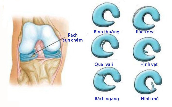 Rách sụn chêm