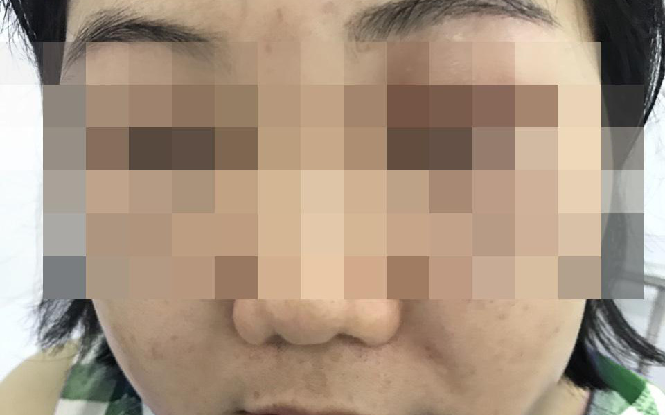 Tế bào gốc làm đẹp: Có phải thần dược để 'nâng cấp' nhan sắc?- Ảnh 6. Mặt sưng phù, nổi mẩn đỏ vì tiêm