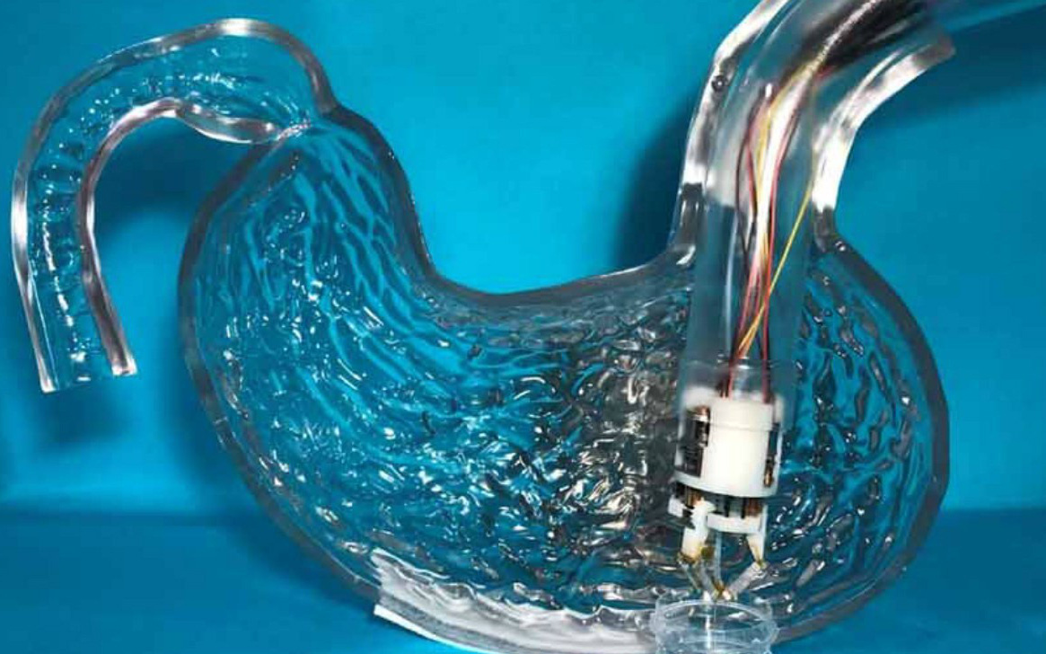 Điều trị cho người béo phì bị gãy xương chậu bằng công nghệ dựng hình 3D - Ảnh 1.