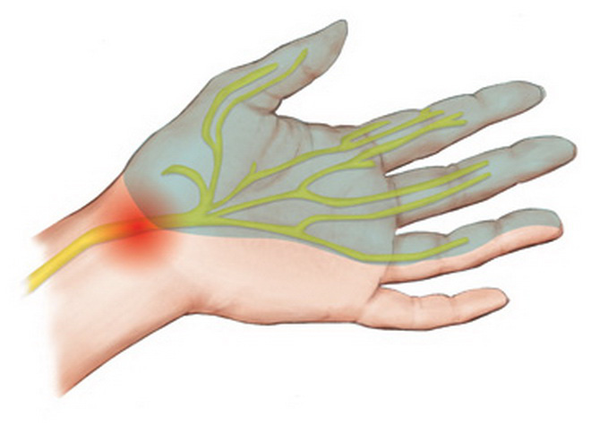 Операция карпального канала кисти. Синдром карпального канала кисти. Карпальный туннельный синдром. Что такое синдром карпального канала на руке?. Карпальный туннельный синдром рентген.