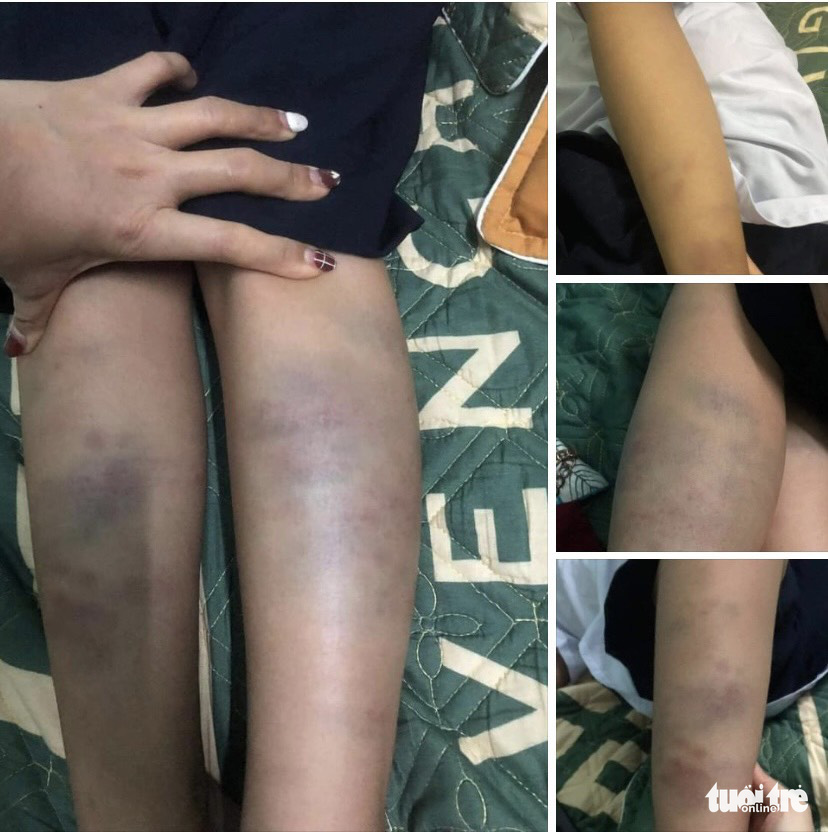 Vụ học sinh lớp 1 bầm tím tay chân: phụ huynh yêu cầu cấp quận xác minh lại - Ảnh 2. Vụ học sinh lớp 1 bầm tím tay chân: phụ huynh yêu cầu cấp quận xác minh lại - Ảnh 2.