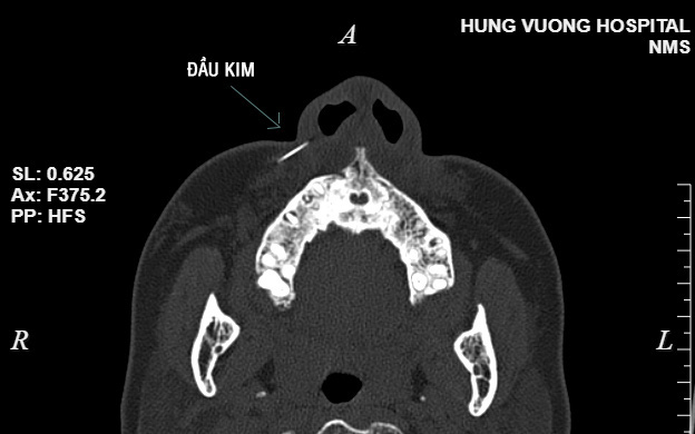 Kim tiêm dài 1cm nằm trong má khách hàng tiêm chất làm đầy tại salon tóc ở Hà Nội