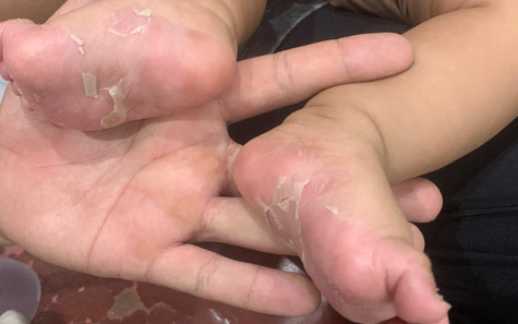 Căn bệnh từng là nan y, nay lại được mệnh danh là 'kẻ trá hình hoàn hảo'- Ảnh 2. Bé trai 3 tháng tuổi lây bệnh giang mai từ mẹ, coi chừng nhầm với bệnh khác