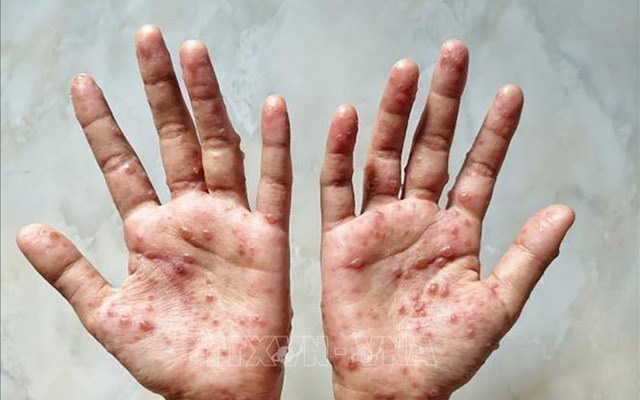 Cà Mau có ca nghi mắc đậu mùa khỉ đầu tiên- Ảnh 1. Bóng nước nổi trên da tay bệnh nhân đậu mùa khỉ - Ảnh minh họa