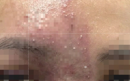 Cô gái trẻ mù mắt sau khi đi spa tiêm filler làm đẹp- Ảnh 2. Tiêm filler nâng mũi "ủng hộ" spa quen, ngờ đâu hoại tử mũi nghiêm trọng