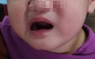 Phát hiện cơ sở của chứng chán ăn tâm thần- Ảnh 3. Cha mẹ chủ quan, bé gái 1 tuổi méo miệng vì liệt dây thần kinh số 7
