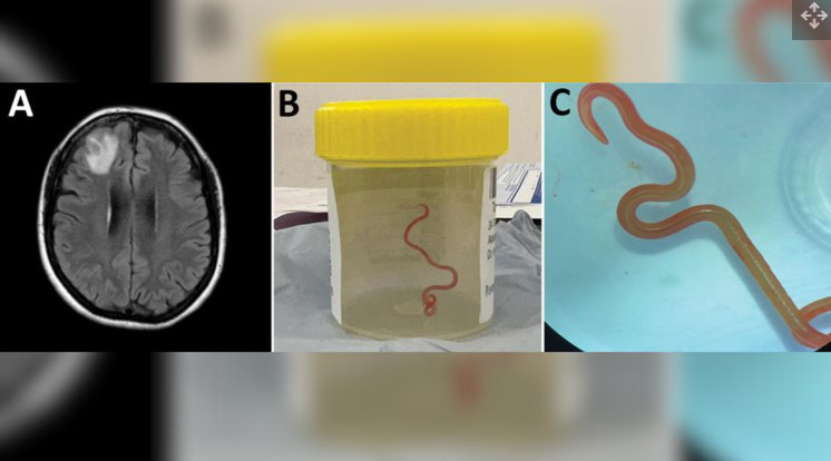 Kết quả chụp cộng hưởng từ (MRI) cho thấy người phụ nữ có một vết thương ở não (trái), sau đó các bác sĩ phát hiện có một con giun - Ảnh: LIVE SCIENCE