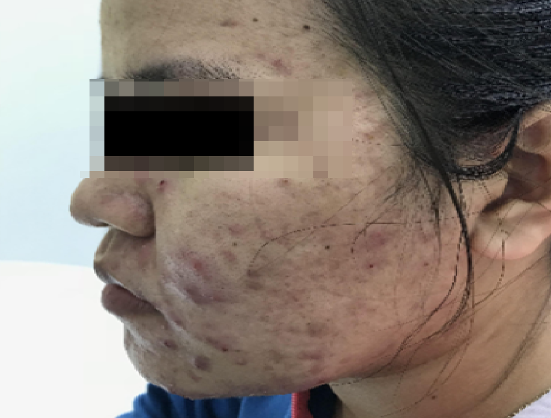 Bad skin nightmare, big nose during pregnancy and childbirth, how to take care of it safely?  - Photo 1.