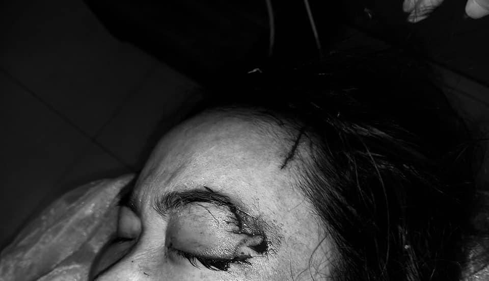 Another dog bite accident: A 40-year-old woman was bitten by a dog, tearing her eye conjunctiva, tearing her tear duct - Photo 1.