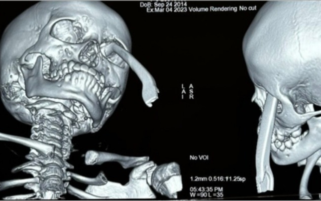 Two Ho Chi Minh City hospitals saved a girl who was stabbed by the hand of a bicycle in her eye socket and skull floor