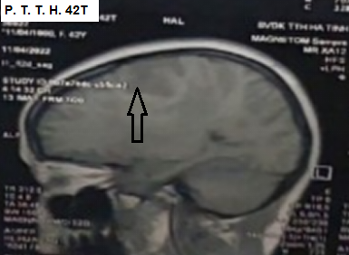 Hình ảnh bệnh nhân u não trước điều trị