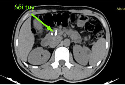 Hình ảnh sỏi tụy trên chụp cắt lớp vi tính của bệnh nhân N. 