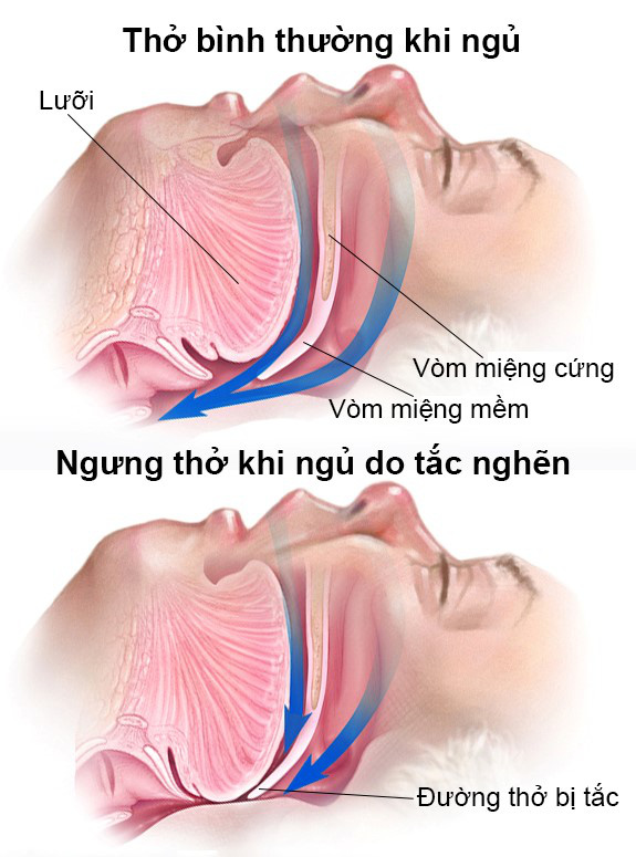 Biểu hiện của ngưng thở khi ngủ - Ảnh BSCC