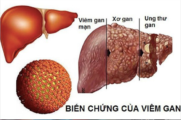 Biến chứng của viêm gan B theo thời kỳ - Ảnh: BYT