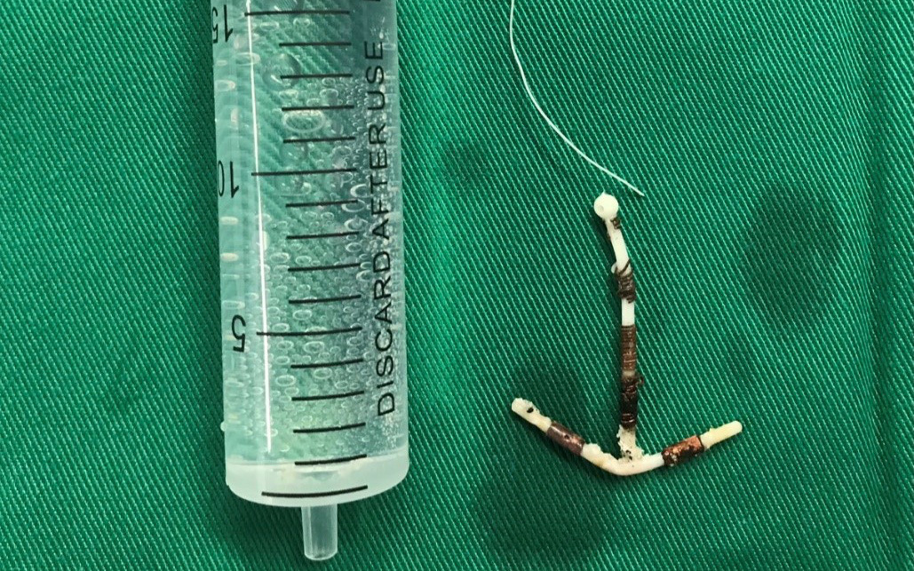 Gãi ngứa niệu đạo bằng cành cây, quý ông phải mổ lấy dị vật 10cm trong bàng quang- Ảnh 3. Vòng tránh thai ‘đi lạc’ vào bàng quang