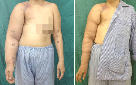 Cứu cánh tay phù to gấp đôi sau điều trị ung thư vú