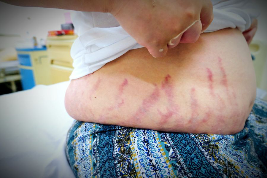 コルチコステロイドを含む点鼻薬の乱用により副腎不全に苦しむ子供たち - 写真: BVCC コルチコステロイドを含む点鼻薬の乱用により副腎不全に苦しむ子供たち - 写真: BVCC